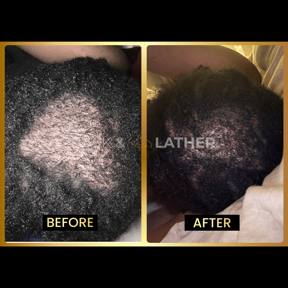 Scalp Stimulator - 3 Month Supply - Bask and Lather Co