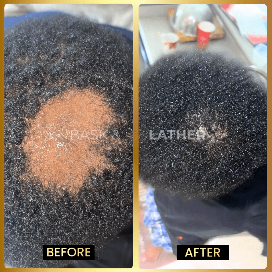 Scalp Stimulator - 3 Month Supply - Bask and Lather Co