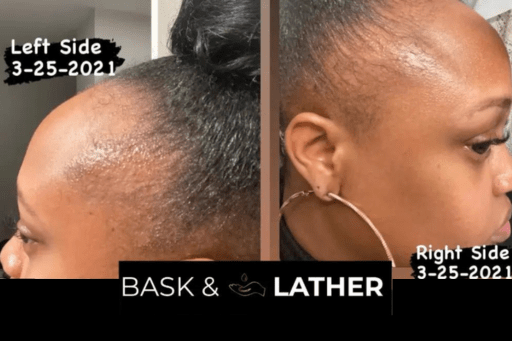 All About Alopecia - Bask  and Lather Co