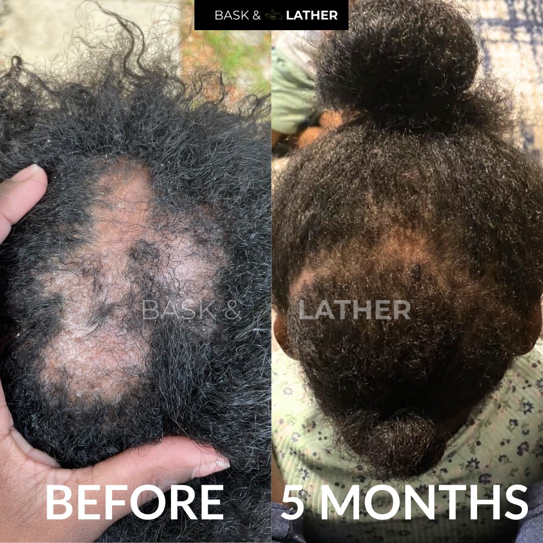 Best Treatments for an Irritated Scalp - Bask  and Lather Co