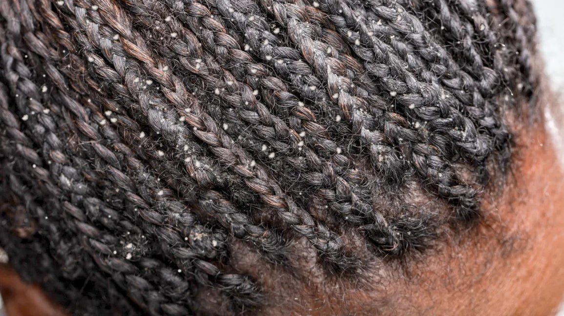 Dandruff, Eczema, or Psoriasis? - Bask  and Lather Co