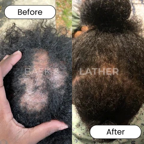 3 Products To Incorporate To Treat Your Scalp Alopecia - Bask  and Lather Co