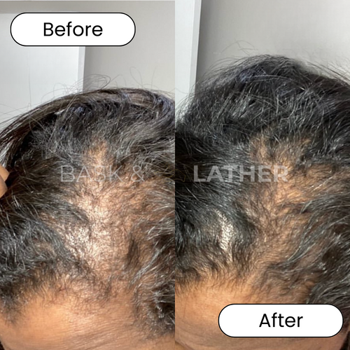 Alopecia Result 3