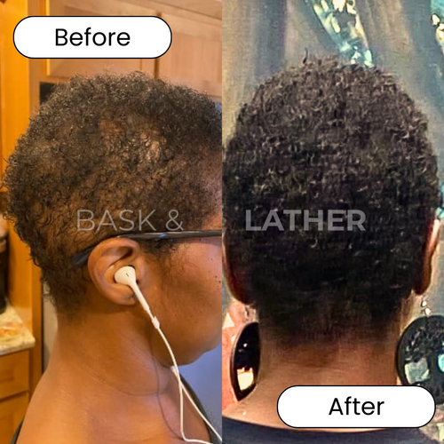 Alopecia Result 4